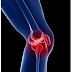 Osteoarthritis Risk Factor and How to Resolve It