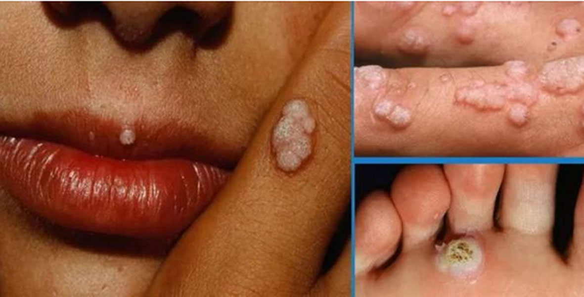 BE AWARE! There Is A New Deadly Disease Even Worse Than HIV! - The