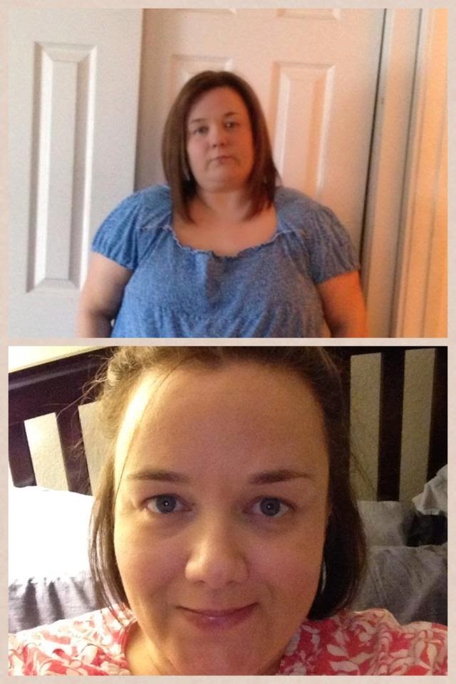 Adjustable Gastric Band Weight Loss Band Surgery Cost Weight Loss Terms Online Database