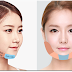 Phẫu thuật khuôn mặt V Line -  Bệnh Viện Thảm Mỹ JW Hàn Quốc 2017