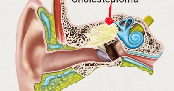 Cholesteatoma Ear Surgery