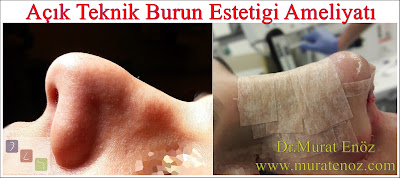 After the open rhinoplasty surgery - Open rhinoplasty or closed rhinoplasty? - Open nose surgery healing process - Open nose surgery is closed nose surgery? - Difference between open and closed nose surgery - Open nose surgery videosu izle - Is it a trail in open nose surgery? - Open technique rhinoplasty - Closed technique rhinoplasty - Rhinoplasty in Istanbul - Rhinoplasty in Turkey - Rhinoplasty photos in Istanbul After the open rhinoplasty surgery - Open rhinoplasty or closed rhinoplasty? - Open nose surgery healing process - Open nose surgery is closed nose surgery? - Difference between open and closed nose surgery - Open nose surgery videosu izle - Is it a trail in open nose surgery? - Open technique rhinoplasty - Closed technique rhinoplasty - Rhinoplasty in Istanbul - Rhinoplasty in Turkey - Rhinoplasty photos in Istanbul