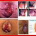 Obat Untuk Menyembuhkan Ambeien thumbnail