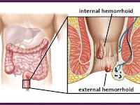 Cara Mengatasi Wasir Yang Keluar Darah