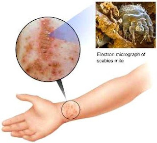 Image Penyebab penyakit gudik