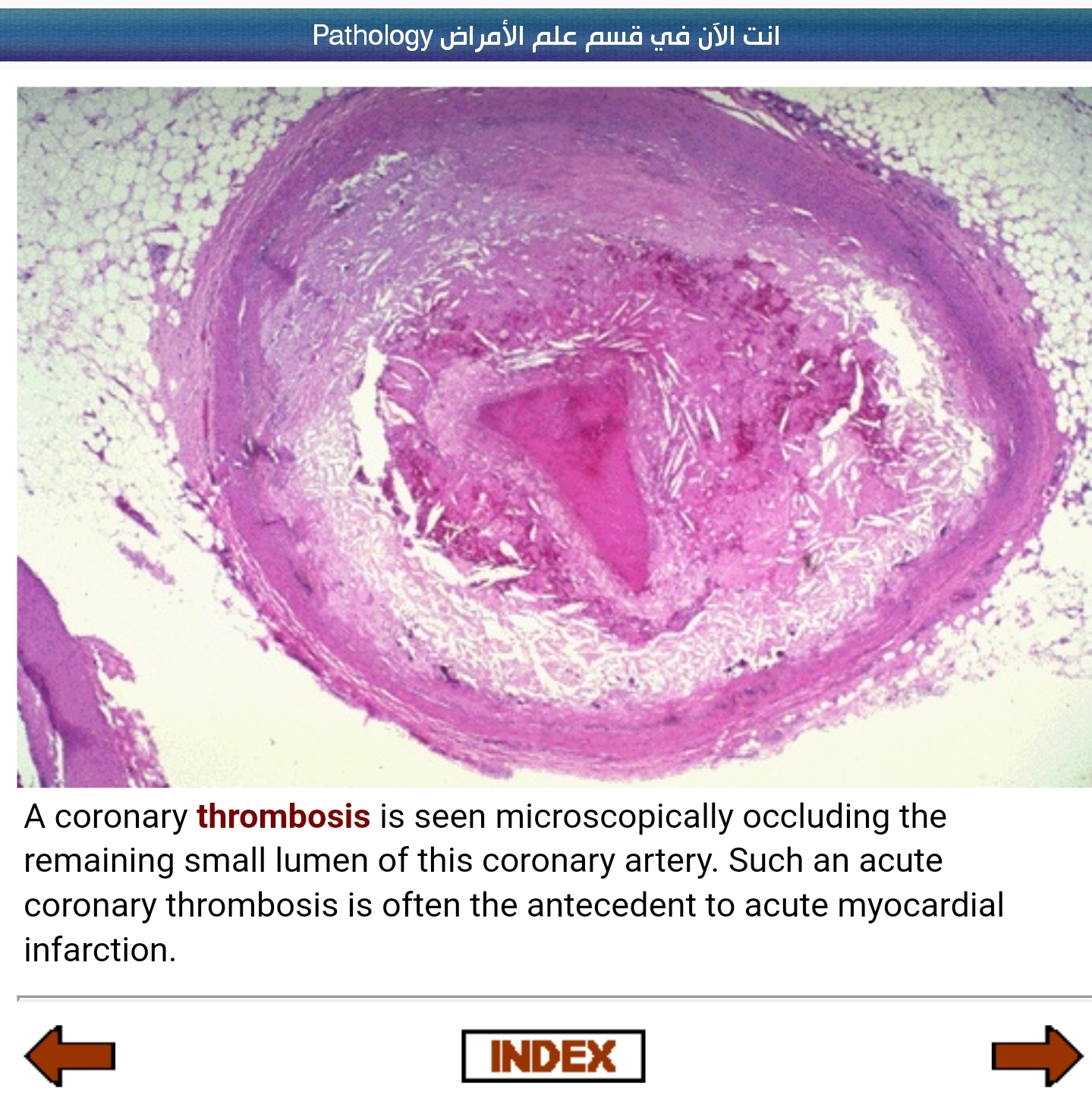 Сердечный тромбоз. Атеросклероз аорты микропрепарат. Стенозирующий атеросклероз венечной артерии микропрепарат. Атеросклеротическая бляшка микропрепарат. Атеросклероз коронарных артерий макропрепарат.