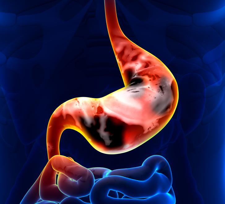 Lifestyle factors are linked to stomach cancer.