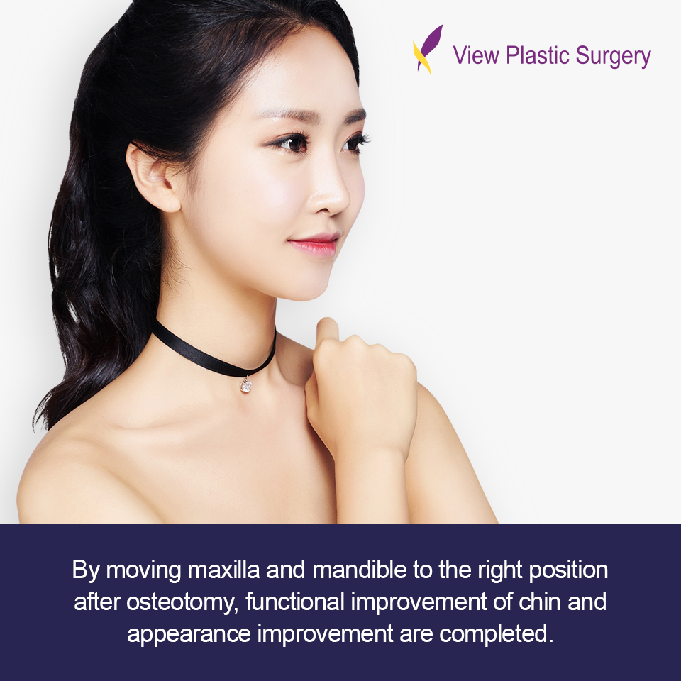 VIEW Plastic Surgery Korea Treat lantern jaw after determining the