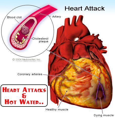 Heart Attack and Hot Water