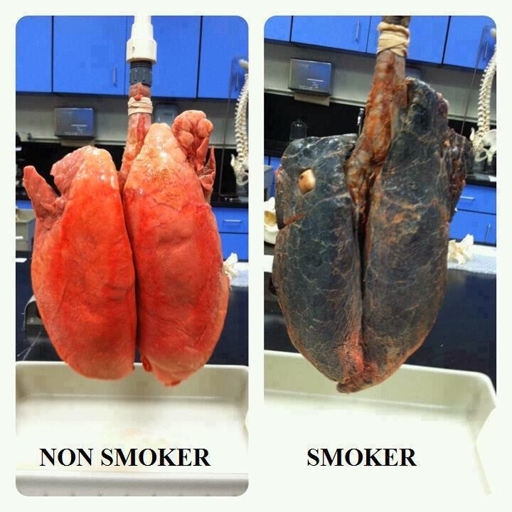 smoker_nonsmoker_lungs.jpg