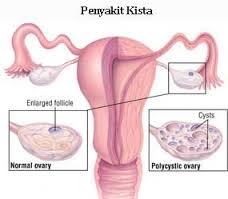 Penyakit KKista http://www.udan.name Penyakit KKista http://www.udan.name