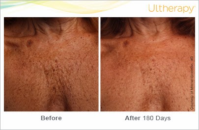 ultherapy 093 014 s c beforeandafter