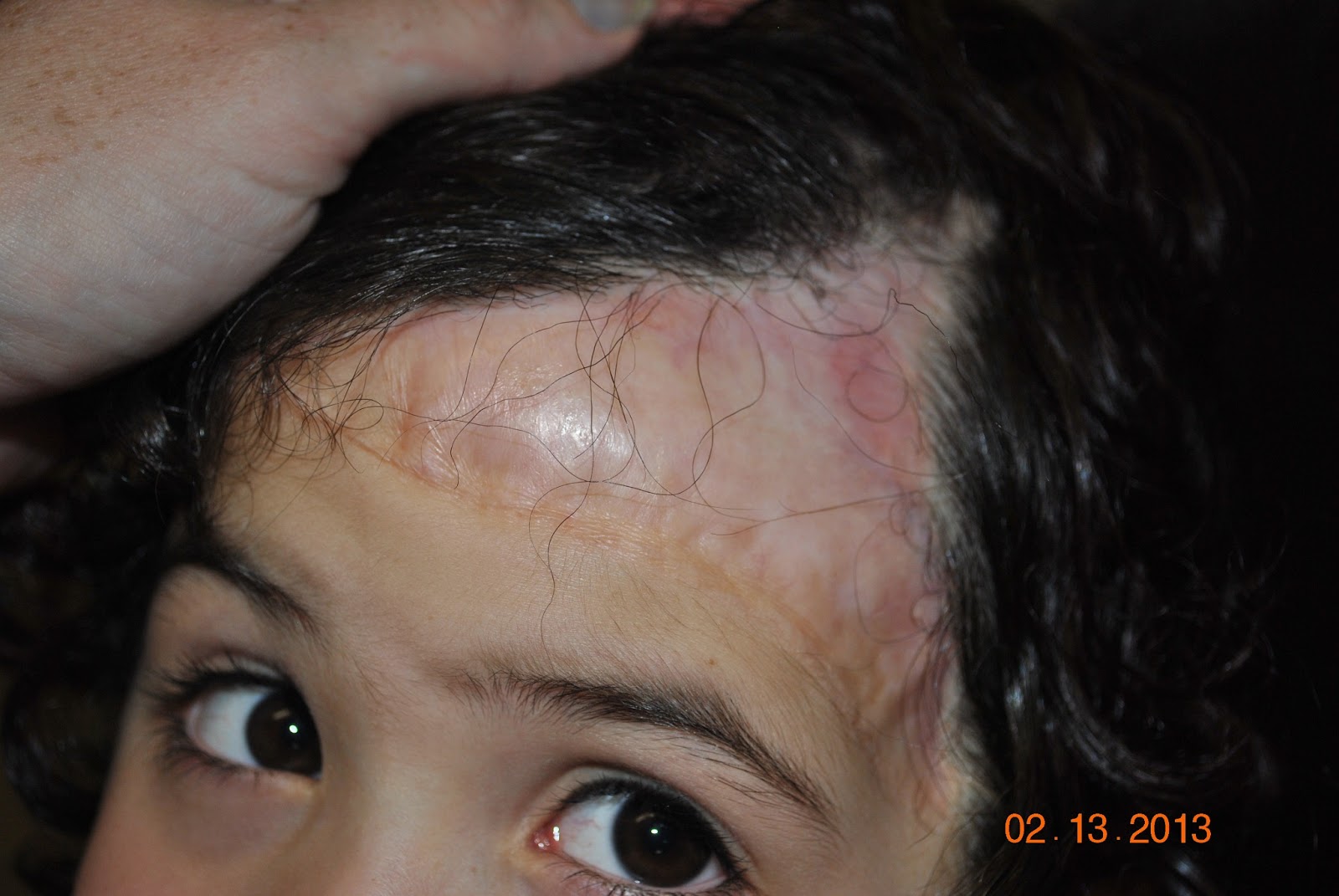 Age 4 Female Scalp Tissue Expanders February 2013