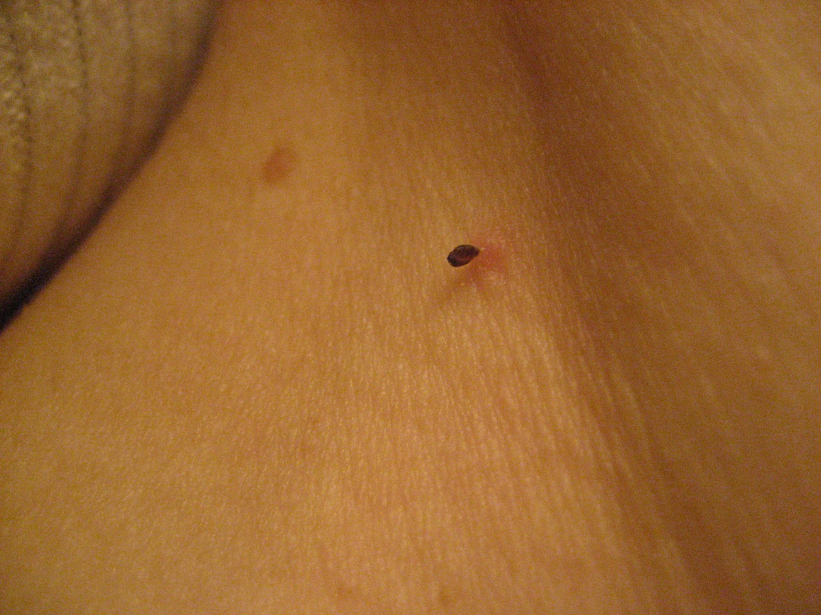 picture of skin tag #10