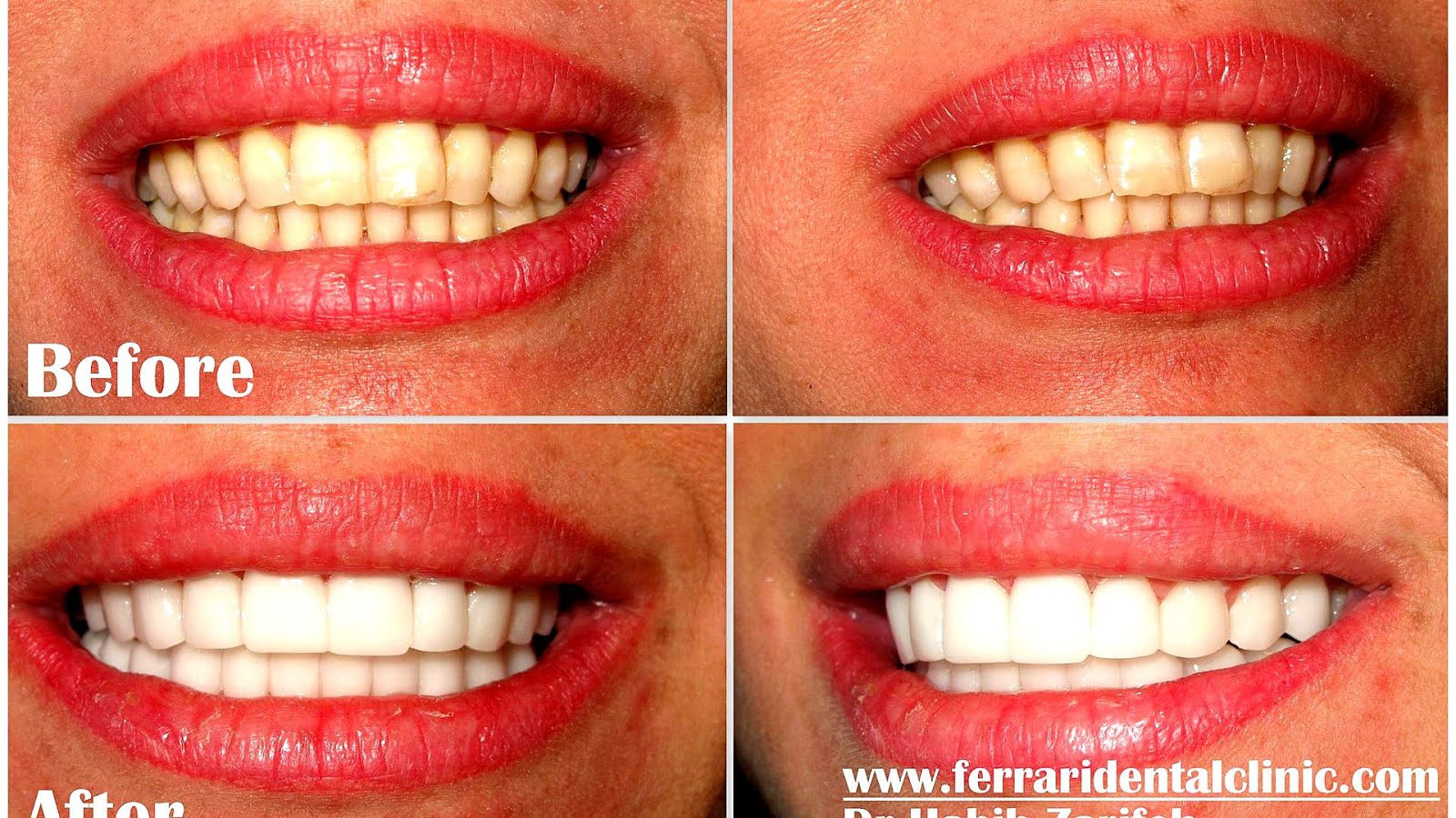 Tooth Implant Side Effects Effect Choices