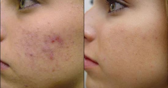 mederma for pimple marks