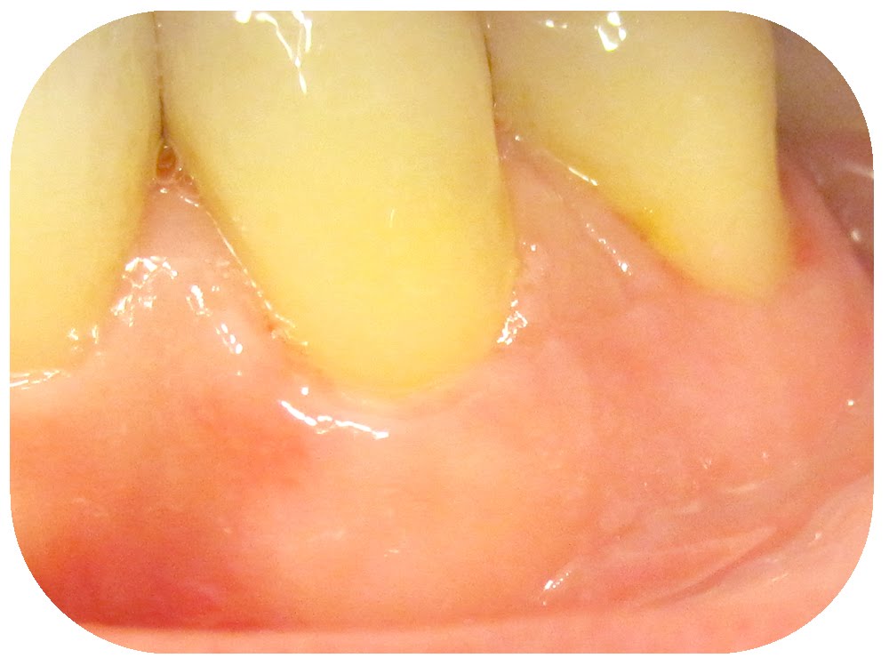 Gum Graft Experience Two Weeks Later Behind