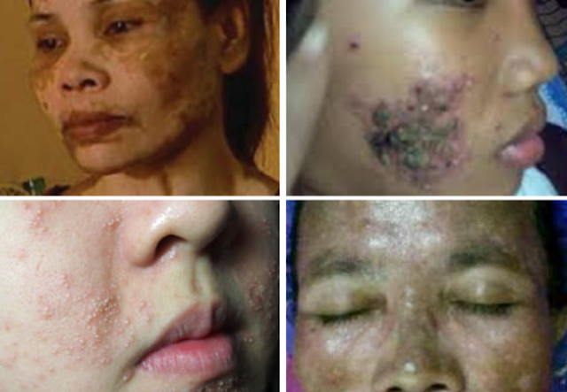 Hati-Hati, Kosmetik Oplosan Bisa Menimbulkan Kerusakan Fatal Pada Tubuh