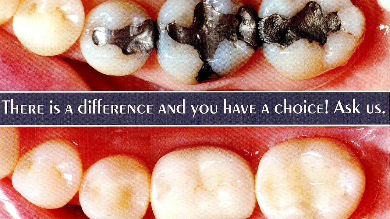 Amalgam Fillings Side Effects Effect Choices
