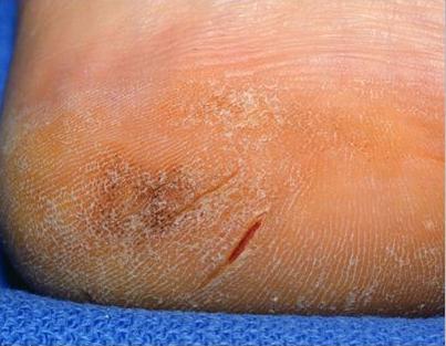 Hiperqueratosis