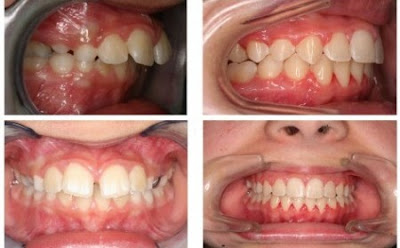 Những đặc điểm nhận biết bệnh nhân bị hô răng là gì?