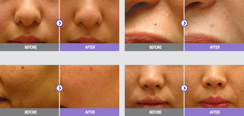 Laser Treatment For Pores On Face Cost Philippines Renewme Skin Clinic: Laser Treatments for Tightening Pores in Seoul, Korea