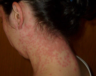 Severe brown tail moth rashes in the patient's nape area brown tail moth rash image
