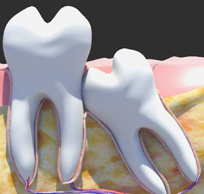 Hậu quả của răng khôn mọc lệch