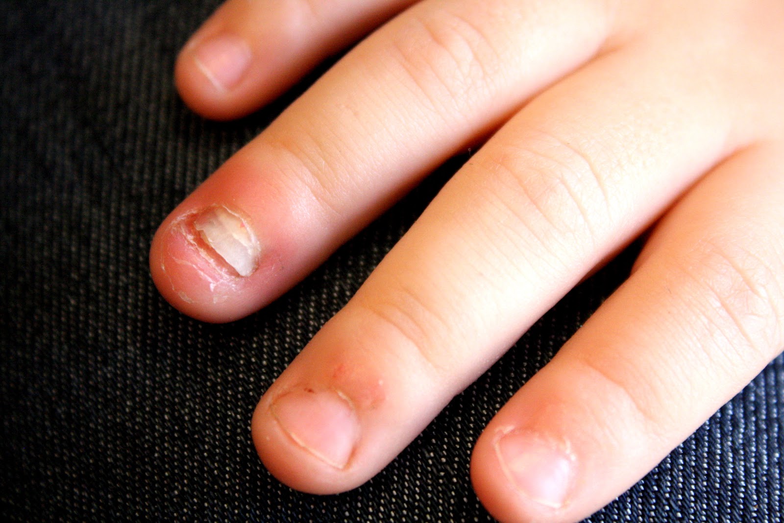 Our Family Alexandra and Her Lost Fingernail!