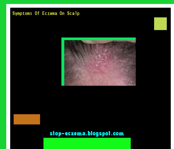 Symptoms of eczema on scalp Stop Eczema