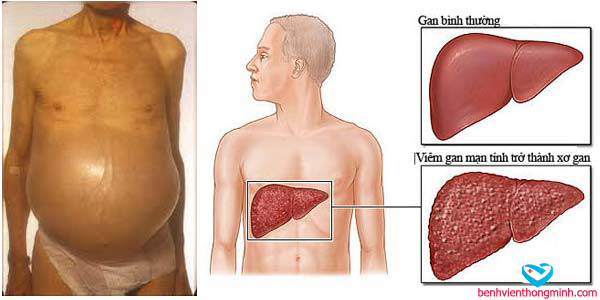 Hậu quả của bệnh Gan