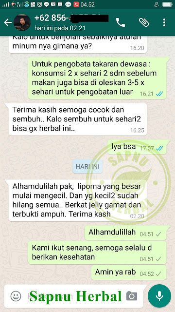 Cara Menghilangkan Lipoma Tanpa Operasi Terbukti Manjur Cara Menghilangkan Lipoma Tanpa Operasi Terbukti Manjur