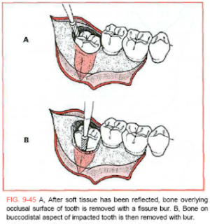 Teknik Odontektomi Kedokteran Gigi