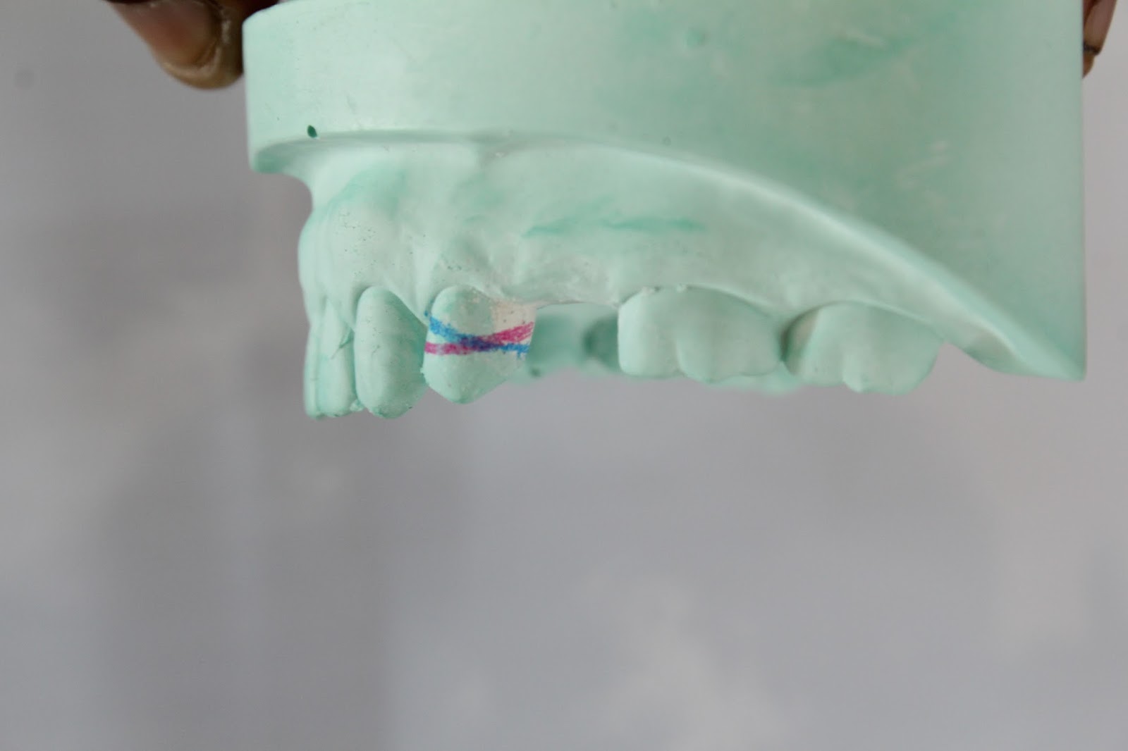 Step by step Guide for Understanding the Prosthodontics Making clasp