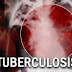 Inadequate funding, threaten Nigeria’s TB control programme