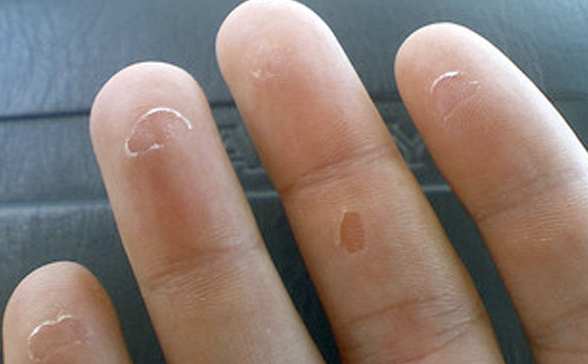 tips mengatasi telapak tangan yang mengelupas