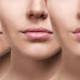 Efeitos da radiofrequência facial na sua pele
