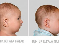 Kepala Bayi Anda Bentuknya Datar? Begini Resiko Pada Tumbuh Kembangnya