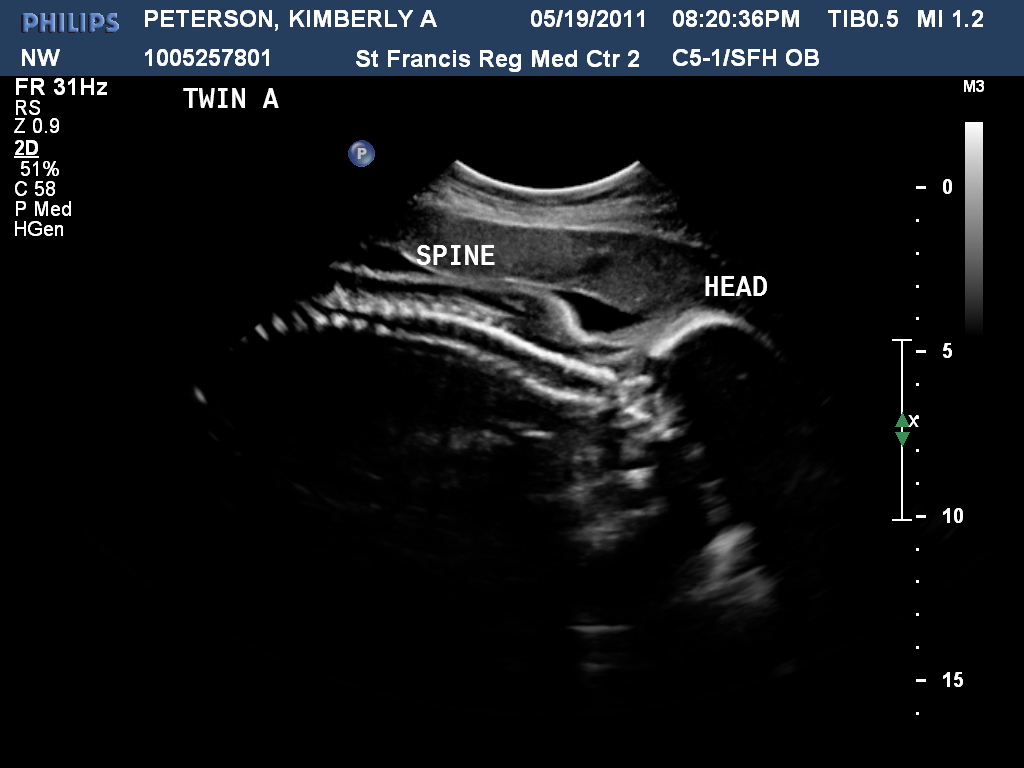 Peterson Family 24 week ultrasound pictures
