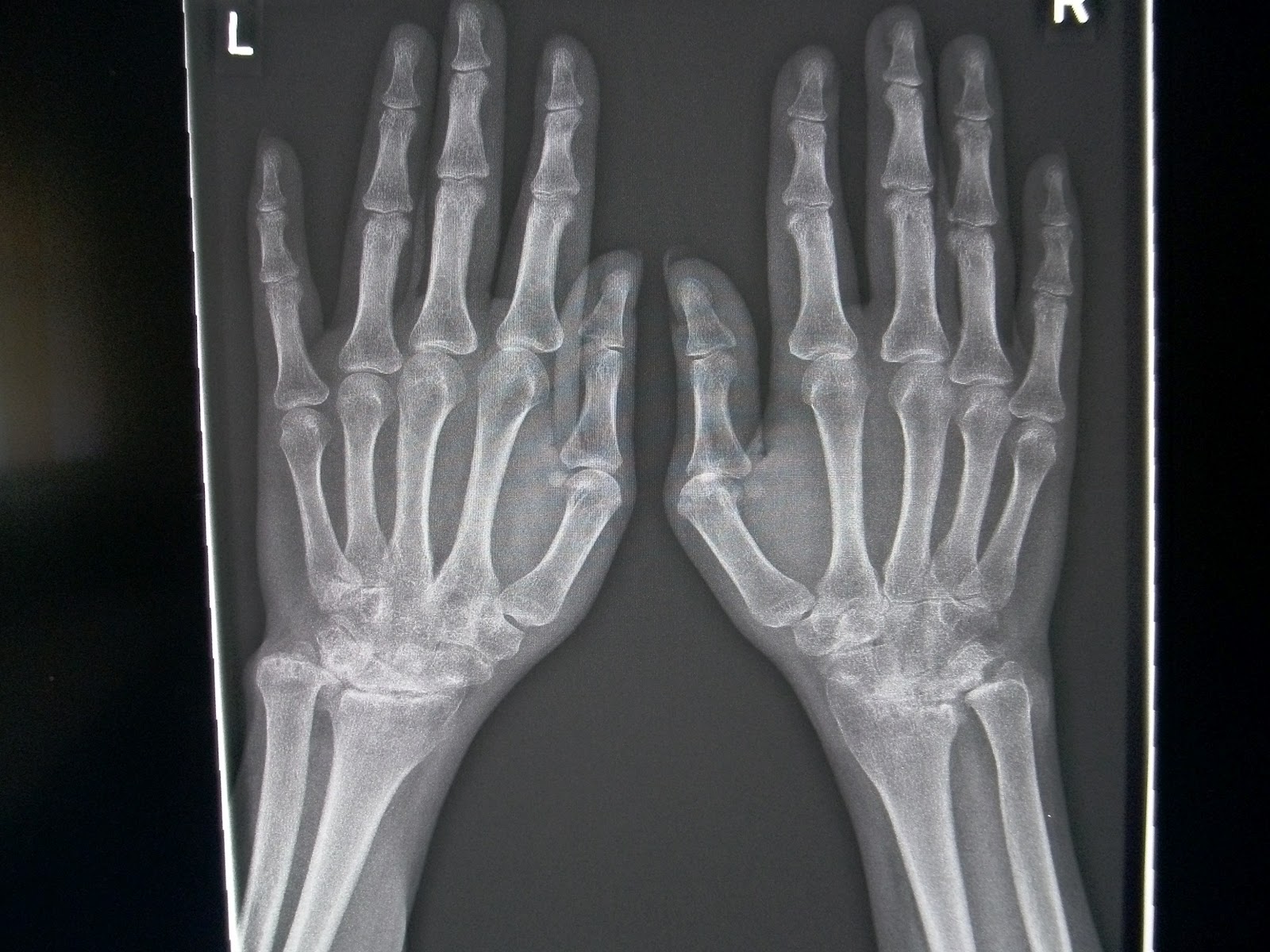 Rheumatologe Rheumatoid Arthritis Radiographic Progression
