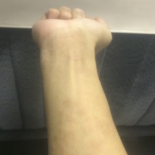 手首の痛み