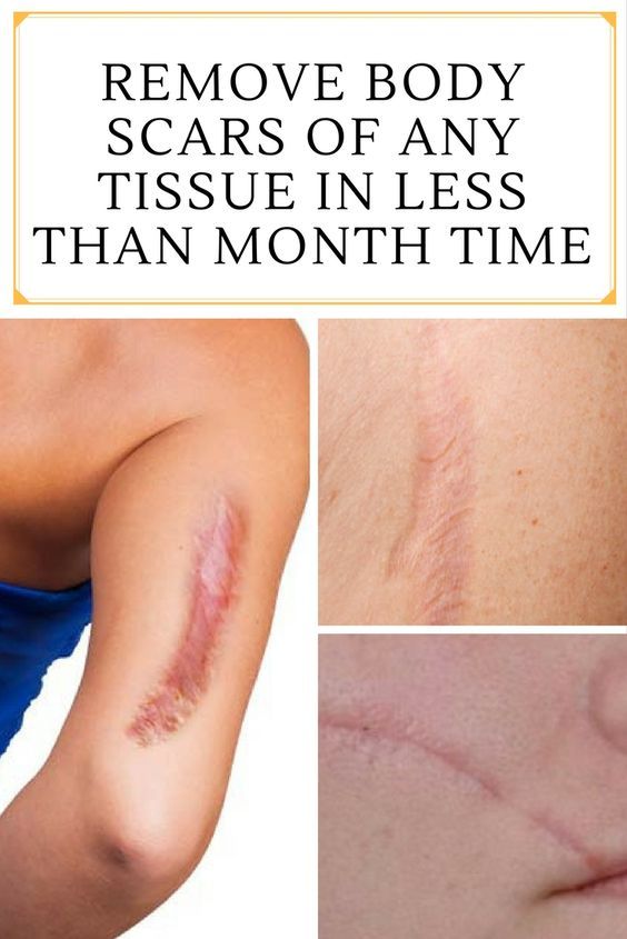 REMOVE BODY SCARS OF ANY TISSUE IN LESS THAN MONTH TIME Health DIY