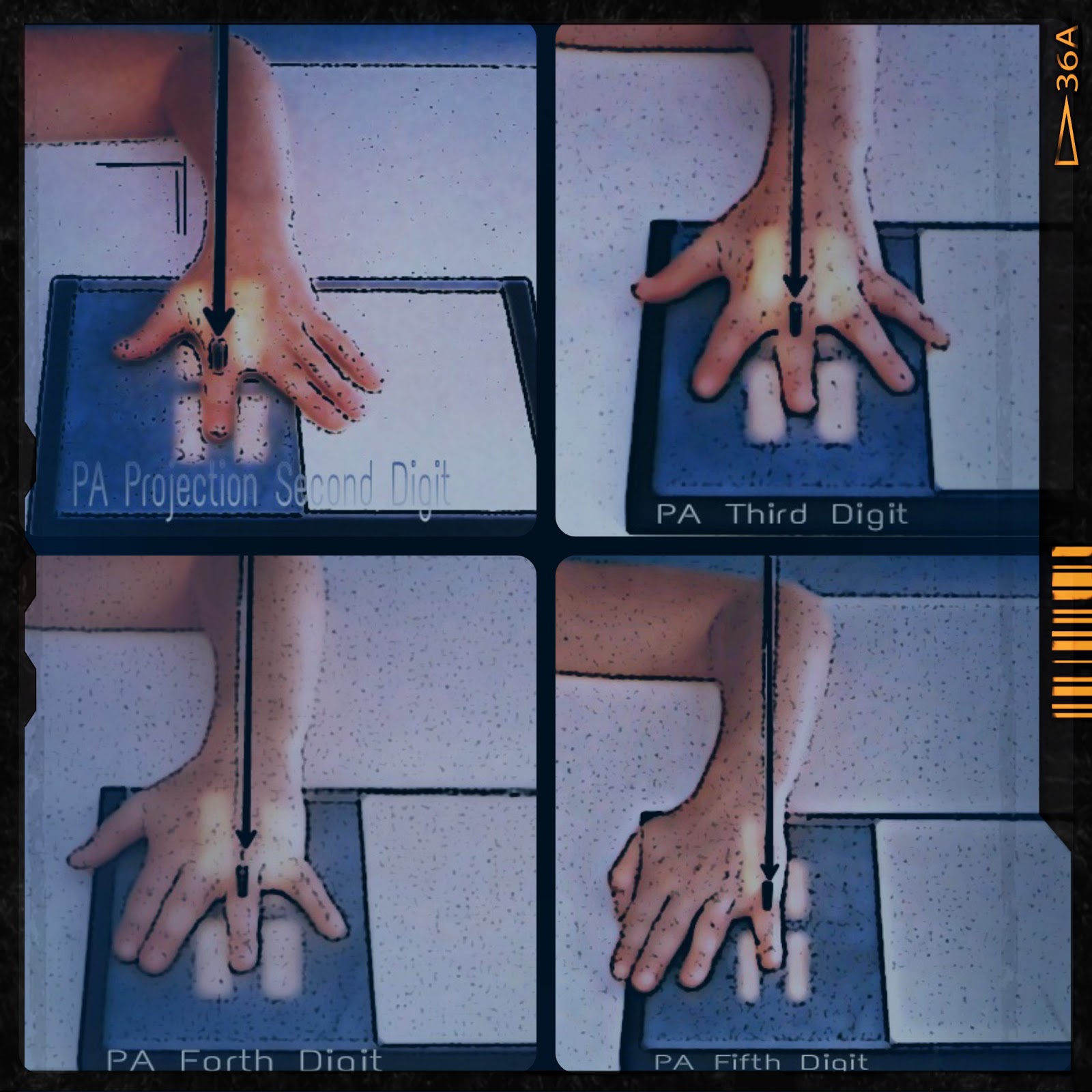 Fingers : PA Projection - RadTechOnDuty