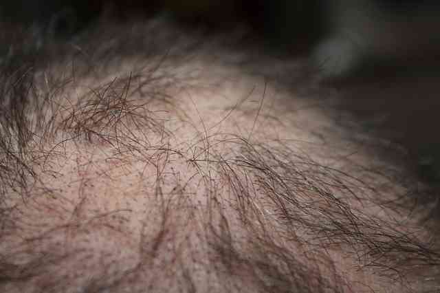 hair loss treatment hair loss treatment