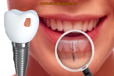 implant diş nasıl yapılır