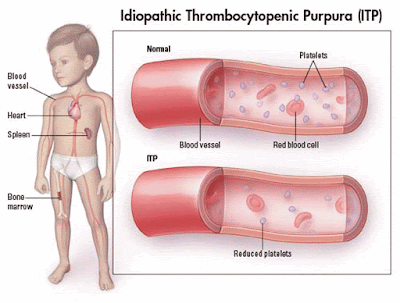 Tingkatkan Platlet Pesakit Idiopathic Thrombocytopenic Purpura (ITP) Dengan Suplemen