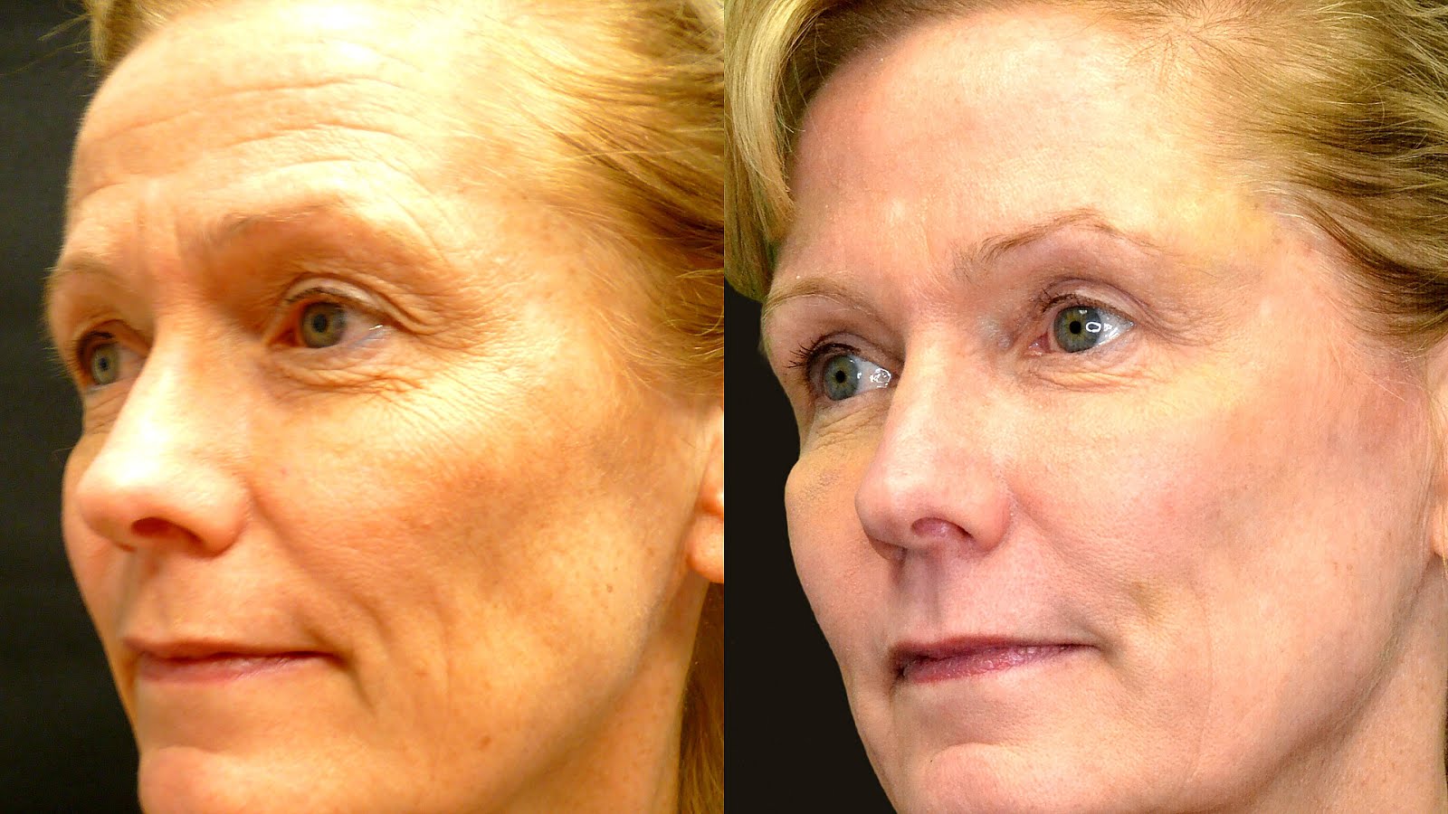 Side Effects Of Botox Injections Effect Choices Side Effects Of Botox Injections Effect Choices