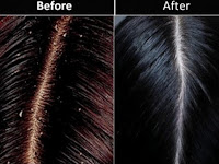 6 Manfaat Menakjubkan Neem Shampo Untuk Rambut Berketombe