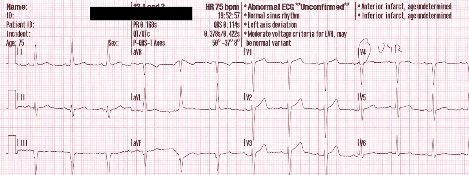Mill Hill Ave Command: Nitroglycerin - Old and New: Pt 2