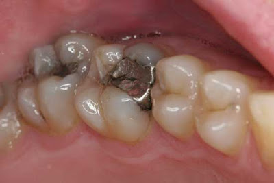 اضرار حشوة الاسنان على صحتكم 